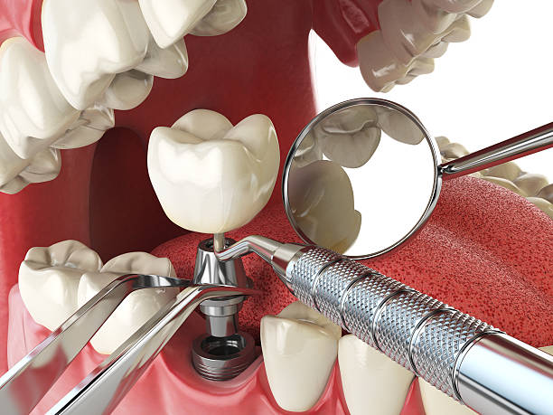 Best Cracked Tooth Emergency Dentist  in Reminderville, OH